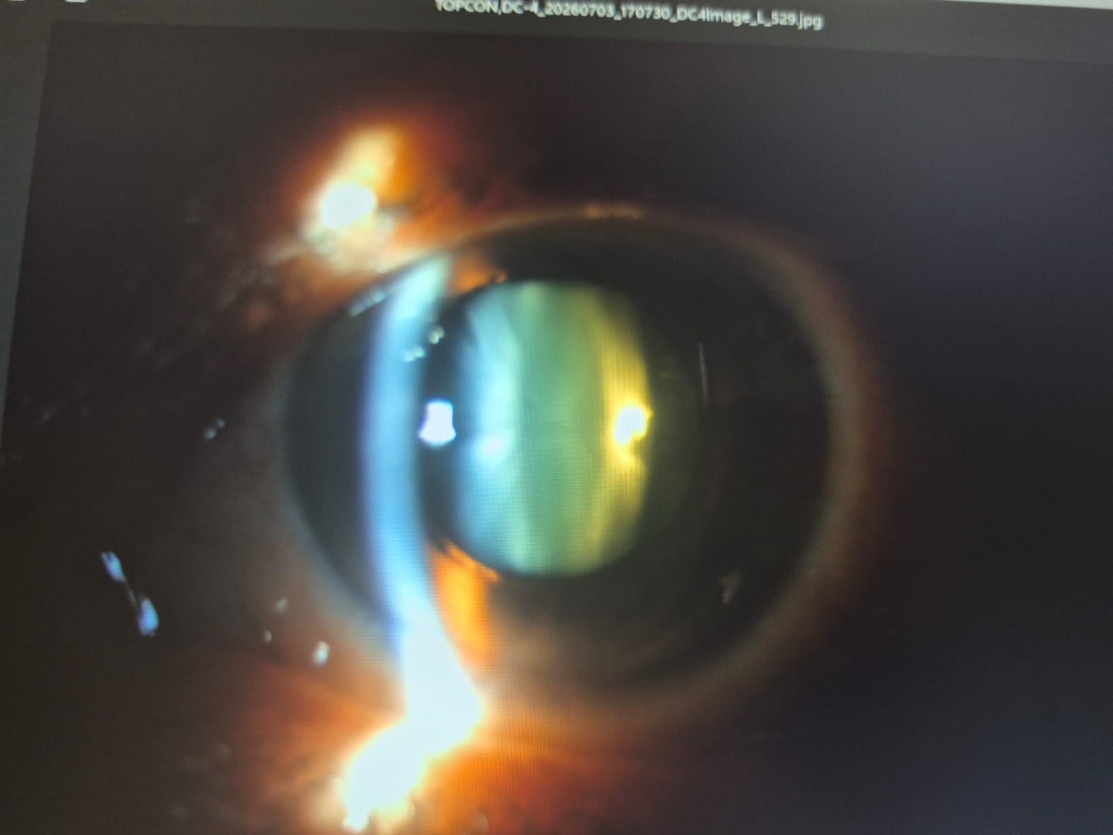 Avant chirurgie de la cataracte - opacification du cristallin